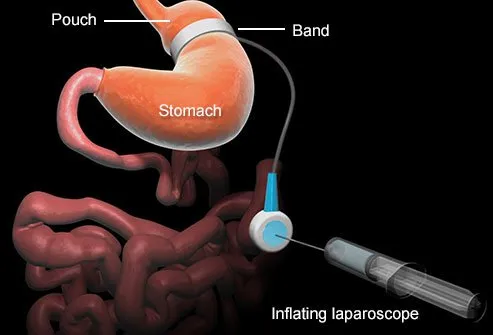 The gastric lap-band is a reversible surgery.