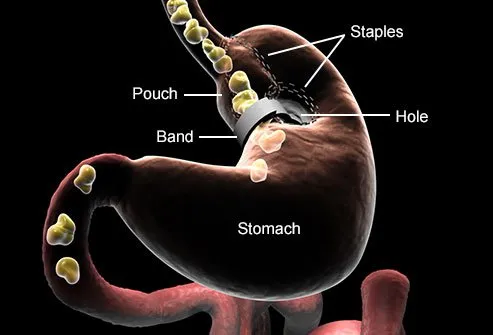 Stomach stapling is considered old-fashioned.