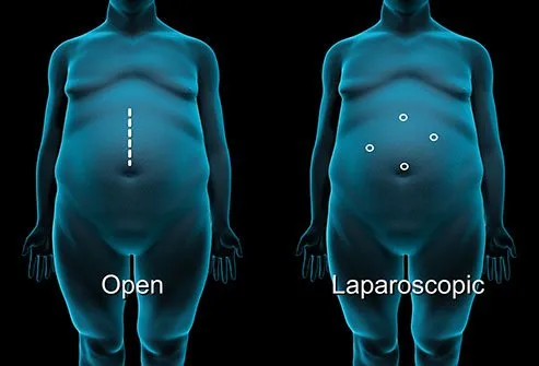 Your surgeon must choose between open surgery and laparoscopic surgery.