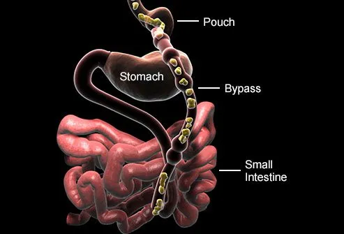 Your intestines must be inserted into your new stomach during gastric bypass surgery.