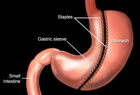 Most of your feelings of hunger are removed, along with most of your stomach, during a gastric sleeve surgery.