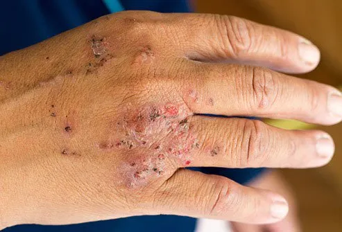 Contact dermatitis happens when your skin comes into contact with something allergic or irritating. 