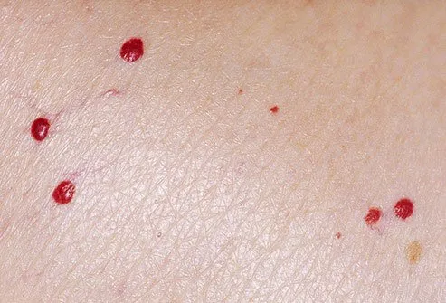 Skin aging spots known as cherry angiomas are small red growths. 