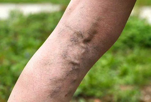 Varicose veins are a feature of aging skin. 