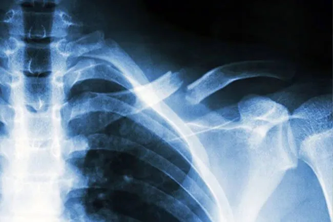 Different bone breaks may be open or closed, partial or complete or displaced or non-displaced.