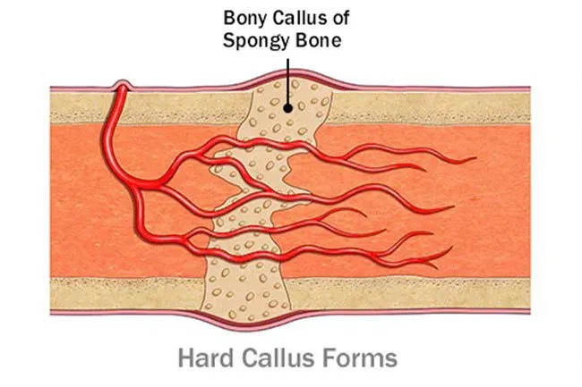 During the hard callus stage, your body forms new bone to the area where it was broken.