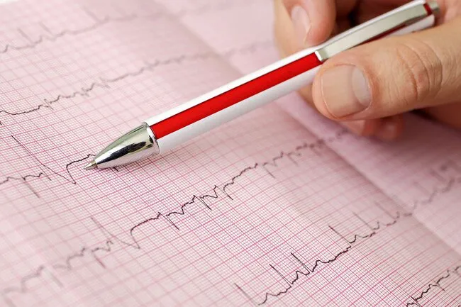 There are four major types arrhythmia heart rhythm disorder.