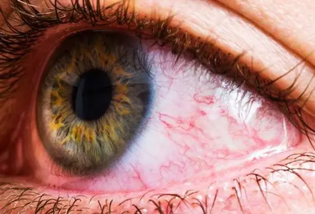 Tiny blood vessels in your eye may expand or burst when they get irritated or infected.