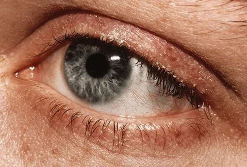 This condition makes your eyelids swell, usually near the eyelashes.