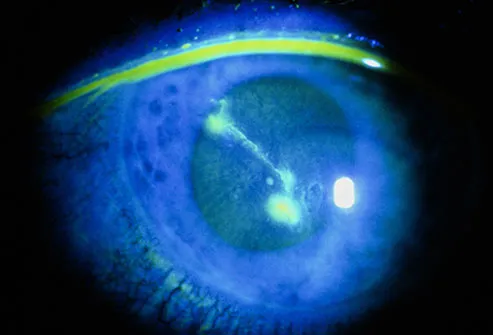 Dirt, sand, and contact lenses can scratch the outside of your eyeball, called the cornea.