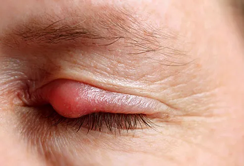 They can make your eye teary, but the other symptoms are usually more obvious, like a swollen, red, painful lump along the edge of your eyelid.