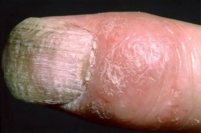 People who have psoriasis may also get psoriatic arthritis. 