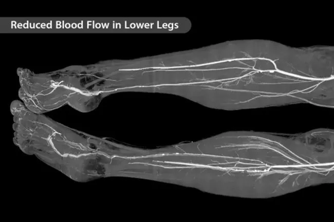 Calf pain can be a sign that your leg muscles aren't getting enough blood.