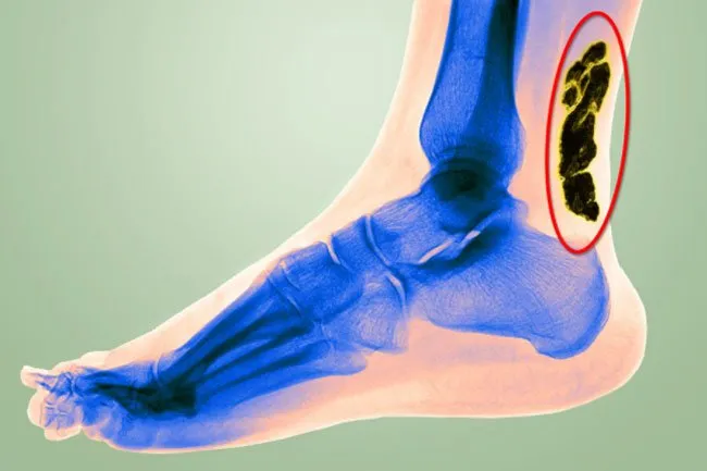 Achilles tendon connects your calf muscle to your heel bone.