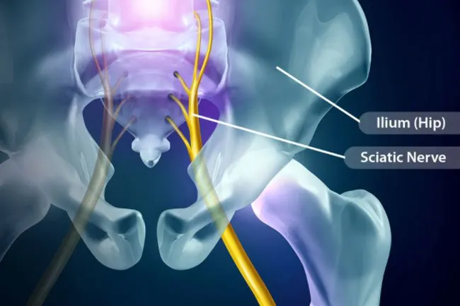 If the sciatic nerve in your lower back gets pinched or inflamed, you'll feel a burning pain down on your leg.