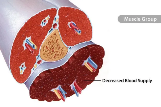 Chronic compartment syndrome may cause swelling or a muscle bulge.