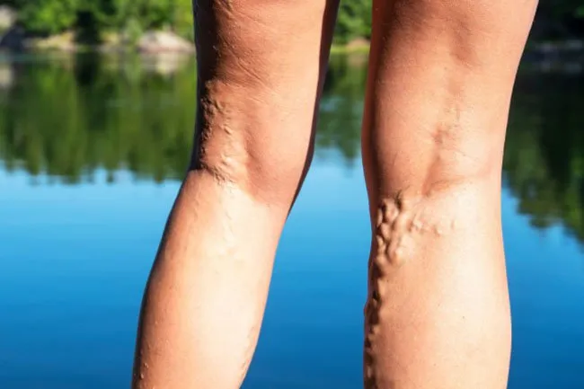 If you stand or walk a lot, the pressure on your legs can cause varicose veins in one or both calves.