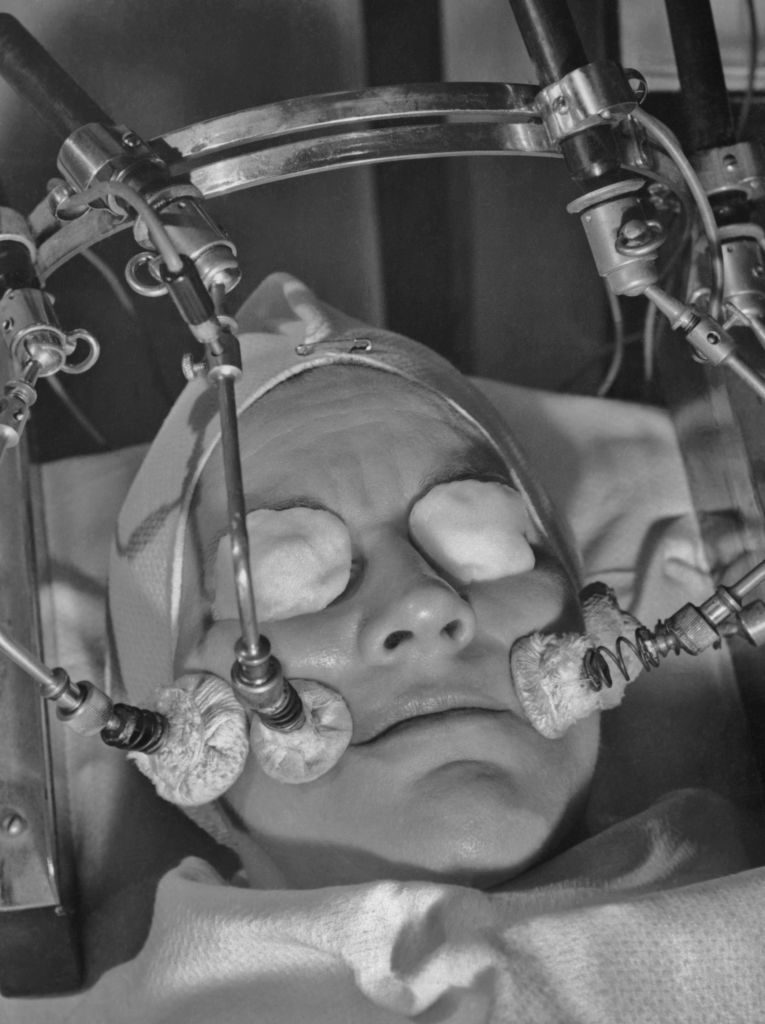 Person lying back with eyes covered, undergoing a vintage eye treatment procedure. Metal instruments are positioned around the face