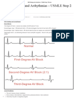 EKG Findings and Arrhythmias - USMLE Step 2 CK Exam