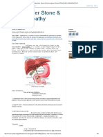 Gallbladder Stone & Homoeopathy - Gallstone and Homoeopathy