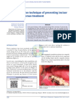 Prevent Incisor Flaring in Fixed Functional Appliance