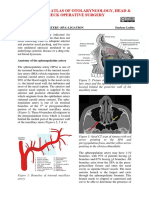 Sphenopalatine Artery - SPA - Ligation