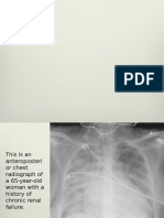 Pulmonary Edema