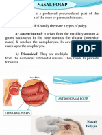 Nasal Polyp