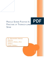 Pedicle Screw Fixation in Fracture of Thoraco-Lumbar Spine