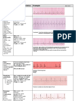 EKG Rhythms