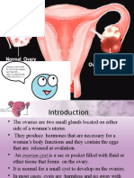 Ovarian Cyst