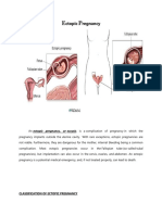 Ectopic Pregnancy - OM