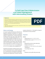 Correction of A Full Cusp Class II Malocclusion and Palatal Impingement With Intermaxillary Elastics