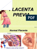 Placenta Previa