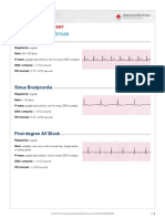 LS Identifying Arrhythmias