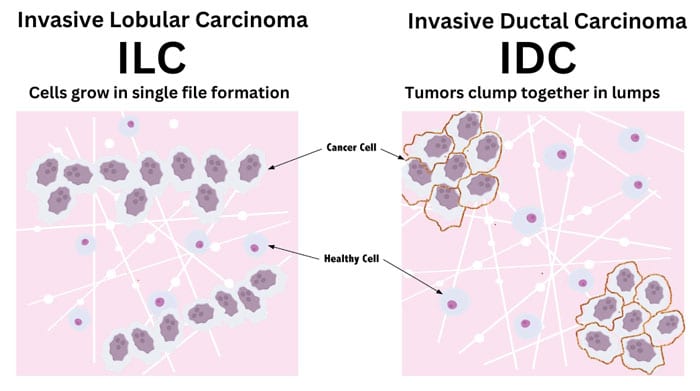 ILC vs IDC