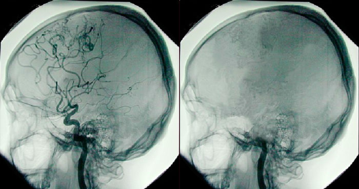 angiogram photo shows brain death loss of blood flow following brain death